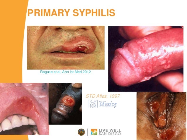 pictures sexual transmitted diseases Pictures sexual transmitted diseases